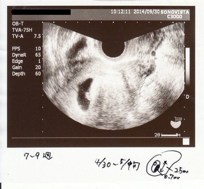 妊娠 7 週 赤ちゃん