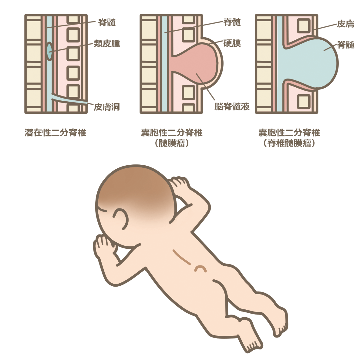 潜在 性 二分 脊椎 赤ちゃん