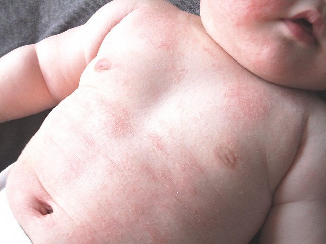 赤ちゃん 小麦 アレルギー 症状