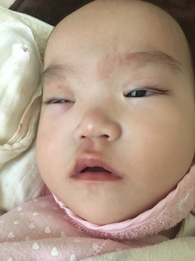 赤ちゃん 目 の 腫れ