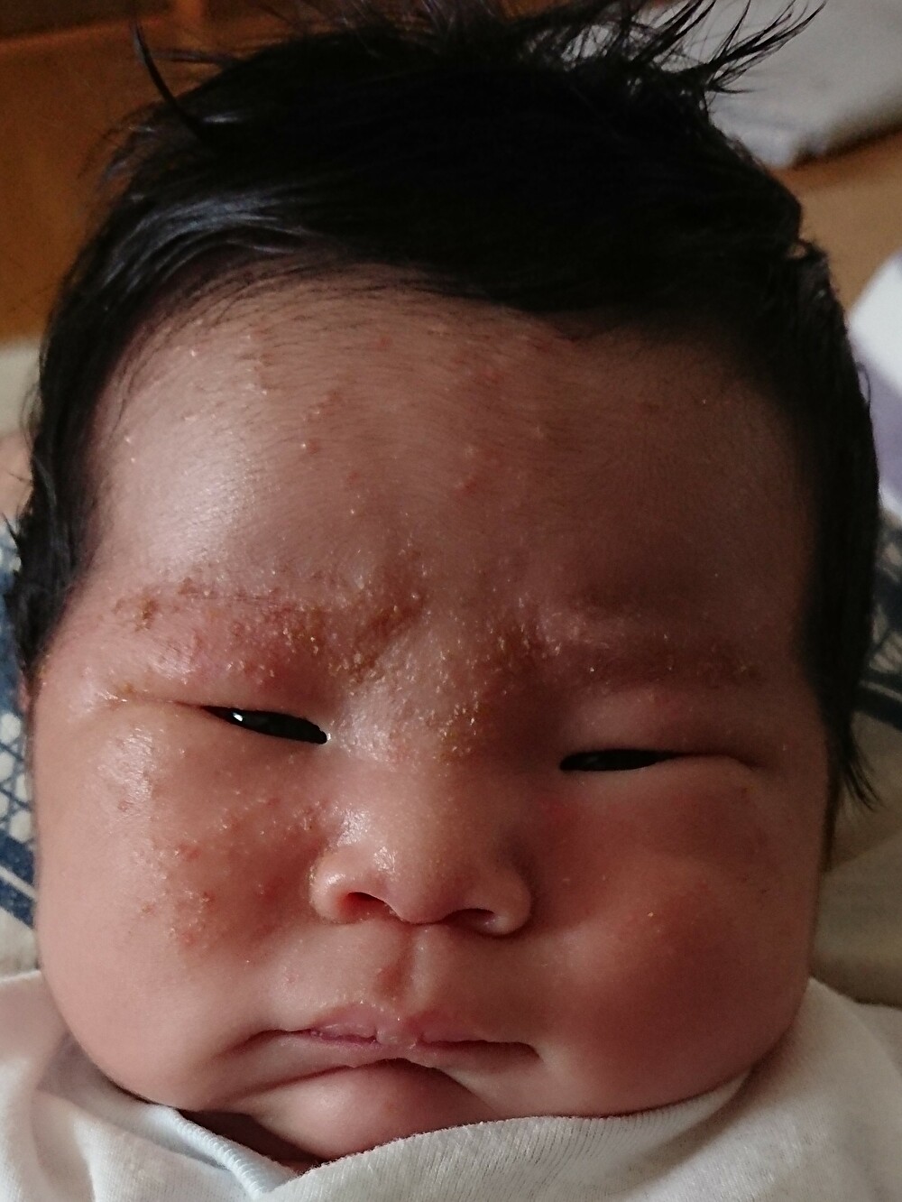 赤ちゃん 顔 に 湿疹